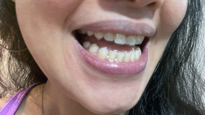 smiledirectclub-justsaying-asia-review-smile-now